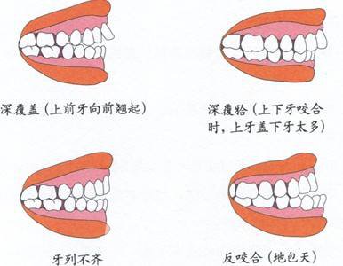 陶瓷托槽矫正要多久?