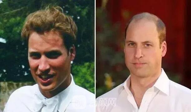 徐峥回应脱发、英国小刺猬因压力大脱毛！不得不说“秃”真是不分界的...