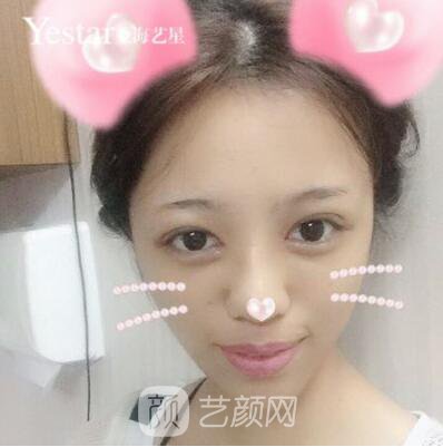 上海艺星切开双眼皮案例，论双眼皮的重要性