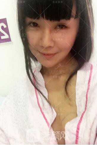 产后妈妈假体隆胸真实案例恢复过程