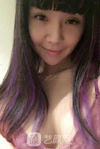 产后妈妈假体隆胸真实案例恢复过程