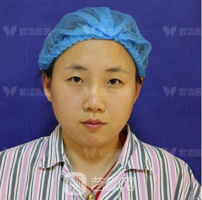 北京紫洁医疗美容全切双眼皮案例过程恢复