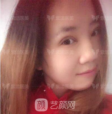 北京紫洁医疗美容全切双眼皮案例过程恢复