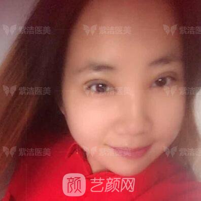 北京紫洁医疗美容全切双眼皮案例过程恢复