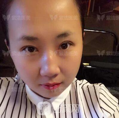 北京紫洁医疗美容全切双眼皮案例过程恢复