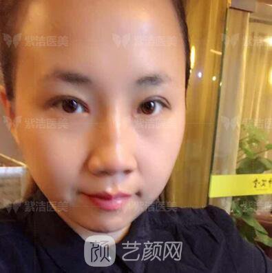 北京紫洁医疗美容全切双眼皮案例过程恢复