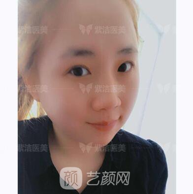 北京紫洁医疗美容全切双眼皮案例过程恢复