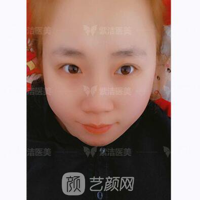 北京紫洁医疗美容全切双眼皮案例过程恢复