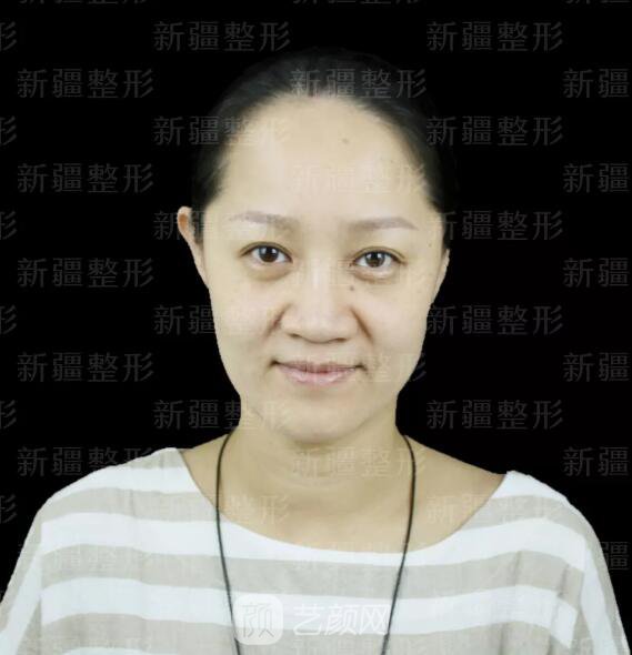 埋线提升提拉只是下垂的皮肤?不,更是我逝去的年华~