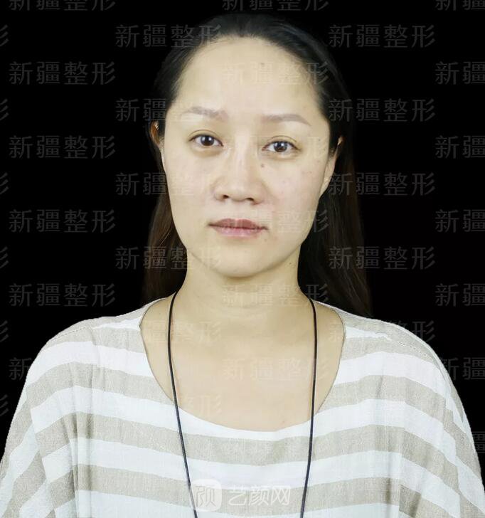 埋线提升提拉只是下垂的皮肤?不,更是我逝去的年华~