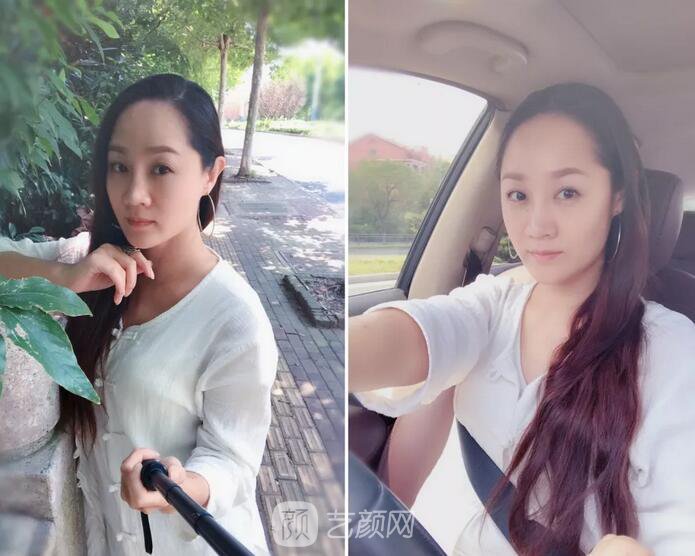 埋线提升提拉只是下垂的皮肤?不,更是我逝去的年华~