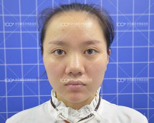 耳软骨隆鼻术后一个月的果，真实日记一则给大家看看~