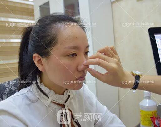 耳软骨隆鼻术后一个月的果，真实日记一则给大家看看~