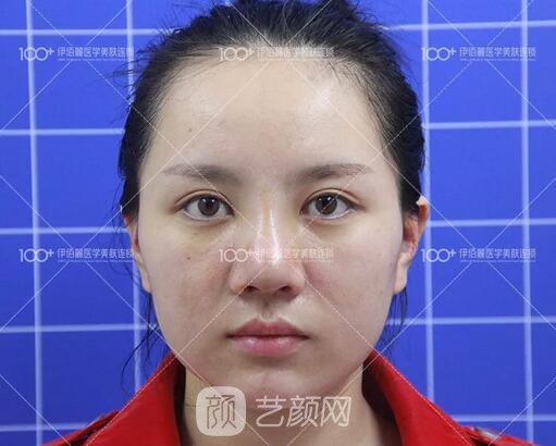 耳软骨隆鼻术后一个月的果，真实日记一则给大家看看~