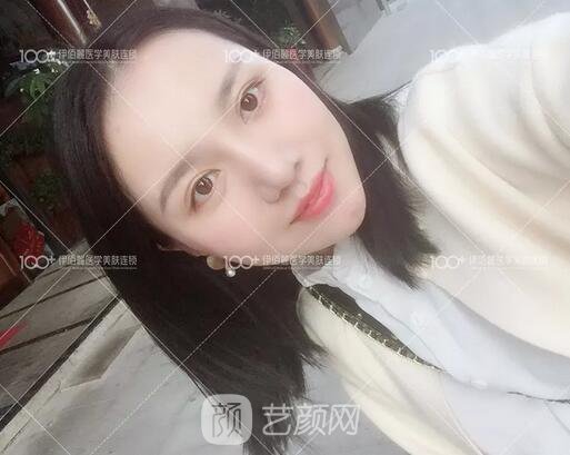 耳软骨隆鼻术后一个月的果，真实日记一则给大家看看~