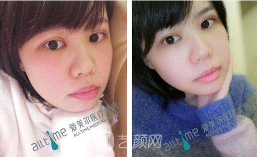 福州爱美尔王*全切双眼皮真实案例