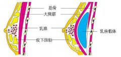 深圳米兰柏羽美体隆胸+2.0新版价目表曝光