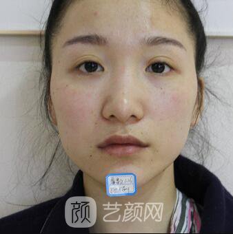 韩式翘鼻-真人案例，直呼我是混血儿