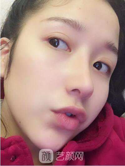 韩式翘鼻-真人案例，直呼我是混血儿