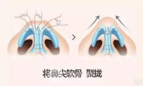隆鼻果出来了朋友们都说好