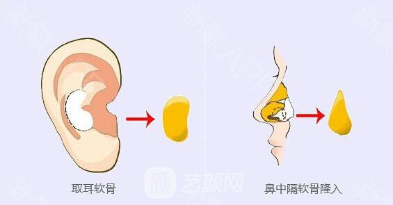 软骨移植重塑鼻尖适应哪些人?