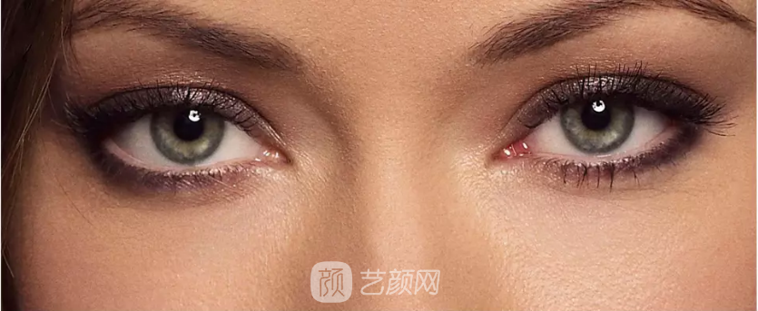 双眼皮手术类型太多，怎么选择?