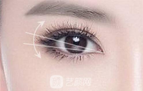 张掖颜艺美整形埋线双眼皮怎么样?