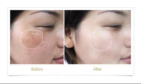 广州曙光美容医院疤痕专家怎样