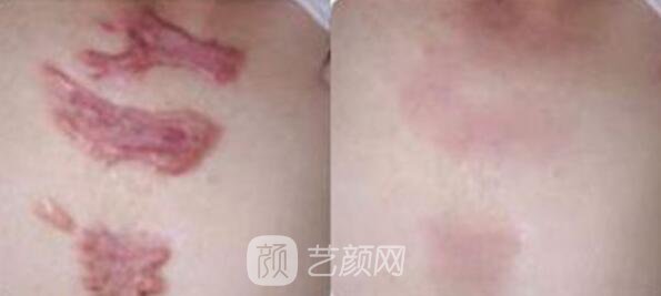 广州曙光美容医院疤痕专家怎样