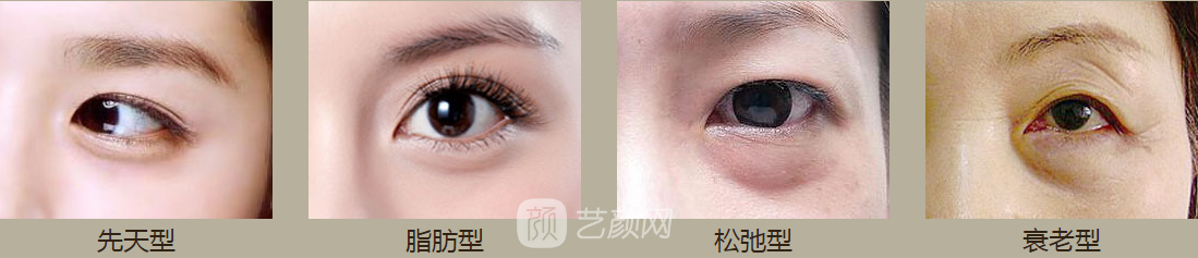 洛阳做眼袋哪里好，费用如何