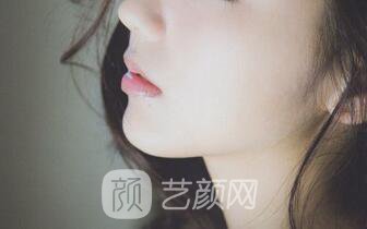 隆鼻案例：隆鼻+双眼皮+下巴已经不是原来自卑的我了~