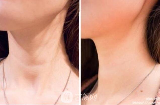 面部美容去皱果怎样?请看真人案例