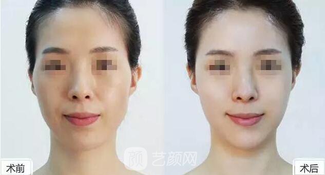 玻尿酸到底是什么东西，小编为你解剖分析