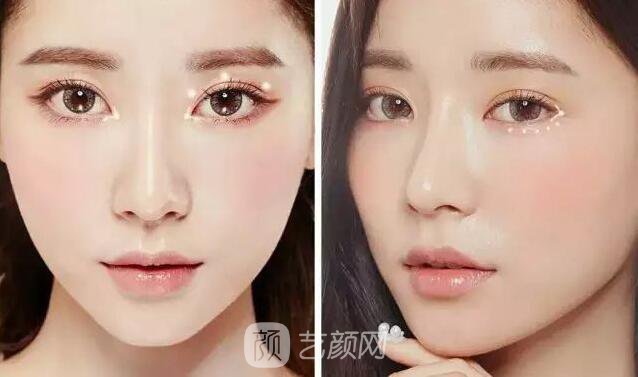 韩式切开双眼皮的真实过程及恢复体验分享~~