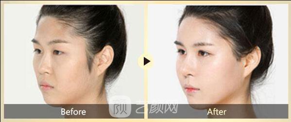 面部去皱术有很多，选适合自己的才是王道