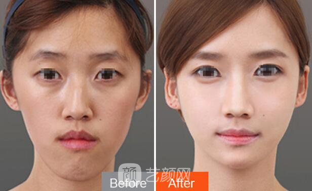 面部填充+隆鼻 变形记为你展示