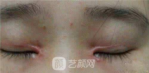 双眼皮手术伤疤