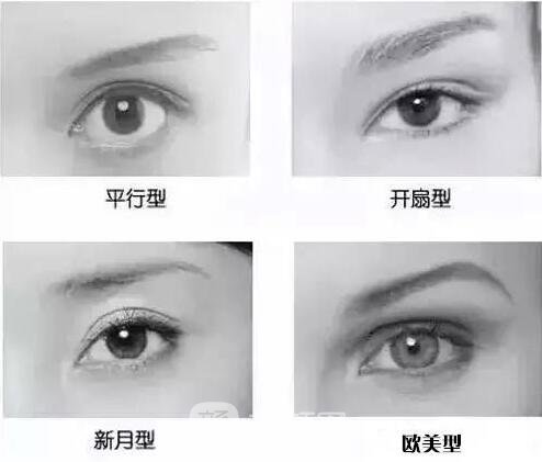 双眼皮手术类型