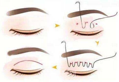 埋线双眼皮手术流程