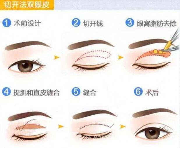 全切双眼皮手术流程