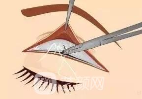 全切双眼皮手术