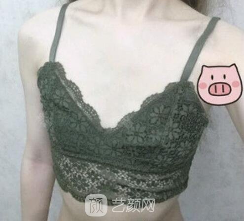 假体隆胸术前照