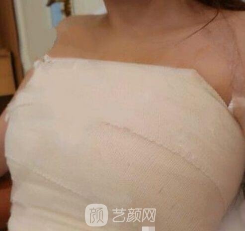 假体隆胸恢复期照片