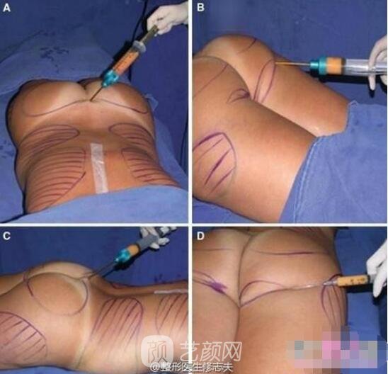 自体脂肪丰臀手术步骤图