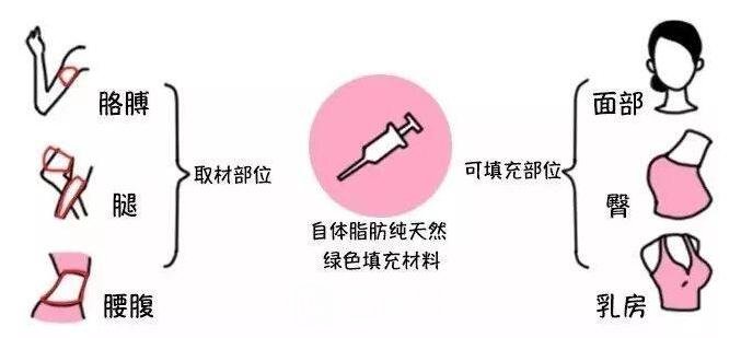 脂肪填充过程图