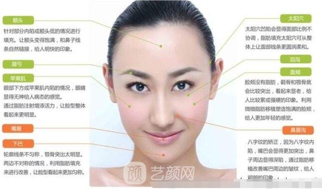 自体脂肪填充苹果肌的后遗症和副作用