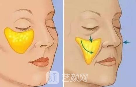 自体脂肪填充苹果肌