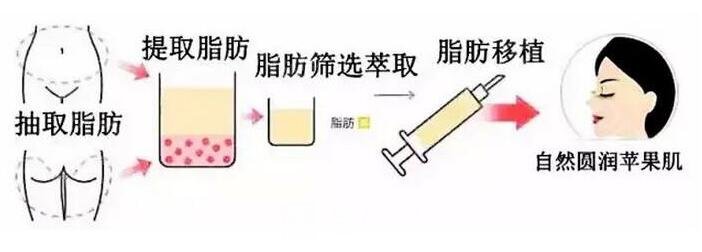 自体脂肪填充苹果肌手术流程图