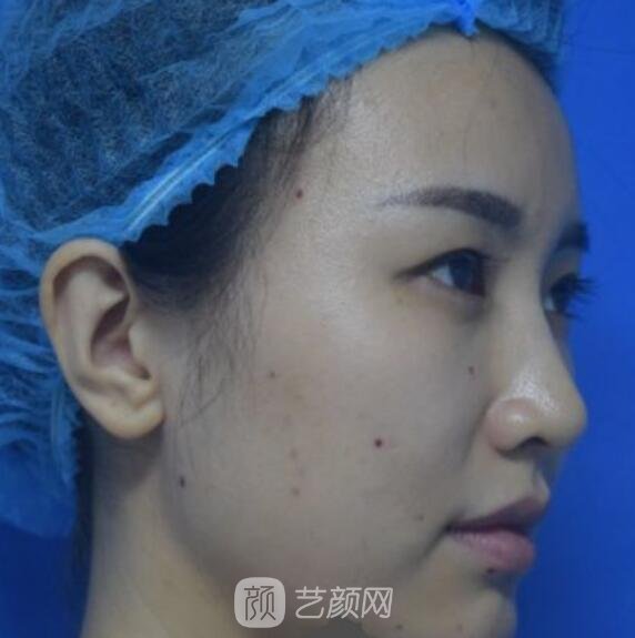 自体脂肪填充术前照片