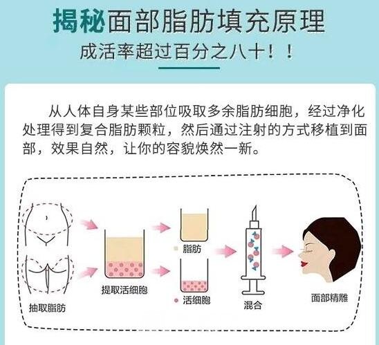自体脂肪填充的过程步骤